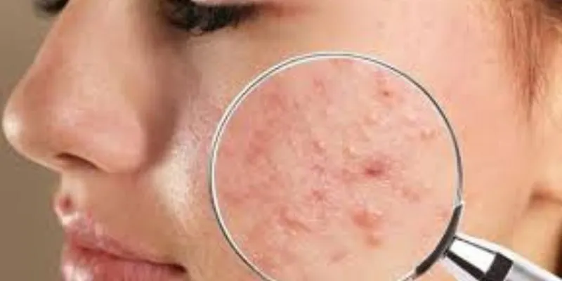 Trị dứt điểm mụn