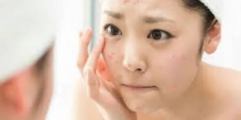 Trị dứt điểm mụn